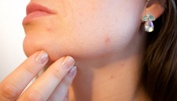 5 règles d’or pour lutter contre l’acné